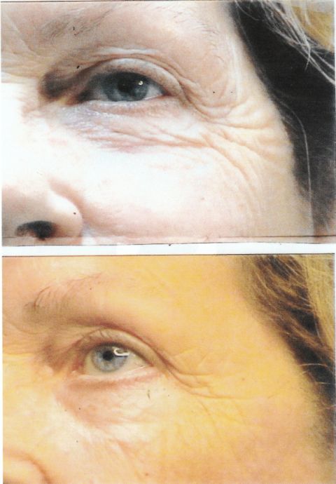 Before and after 6 photo rejuvenation treatments
